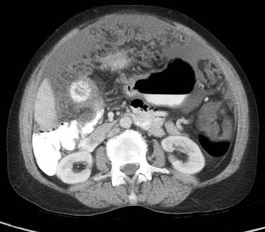 Figure 4: Gallbladder shows multiple hyperdense incarcerated calculi with loss of normal tissue planes. Gross ascites noted with peritoneal enhancement.